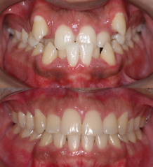 Extrações dentárias na Ortodontia. Santa Maria 31/08/20