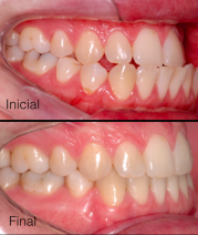 Tratamento ortodôntico corretivo com ancoragem esquelética