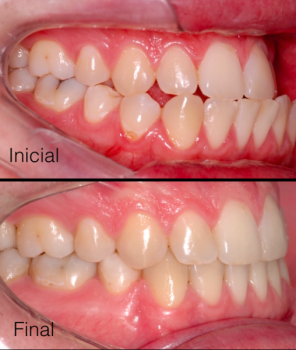 Tratamento ortodôntico corretivo com ancoragem esquelética