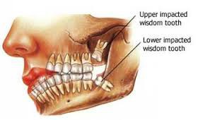 Cirurgia dentoalveolar, cirurgia oral ou bucal 