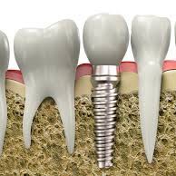 Cirurgia pré-protética e implantes dentários