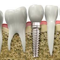 Cirurgia pré-protética e implantes dentários