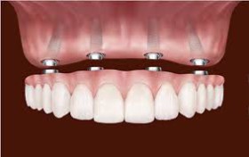 Cirurgia pré-protética e implantes dentários