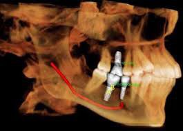 Cirurgia pré-protética e implantes dentários