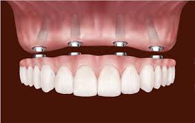 Cirurgia pré-protética e implantes dentários