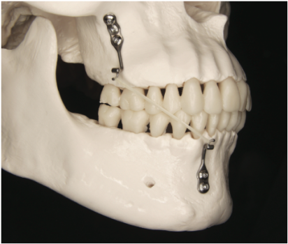 Cirurgia pré-protética e implantes dentários