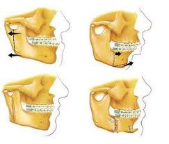 Cirurgia ortognática 