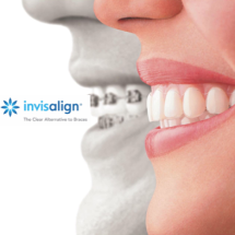 Alinhadores transparentes removíveis (Invisalign e Click Aligner) 