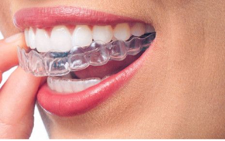 Alinhadores transparentes removíveis (Invisalign e Click Aligner) 