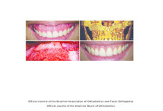 Orthodontic retreatment using anchorage with miniplate to camouflage a Class III skeletal pattern