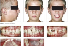 Tratamento ortodôntico de fissura labiopalatina unilateral associada a transposição canino/pré-molar superior: relato de caso 